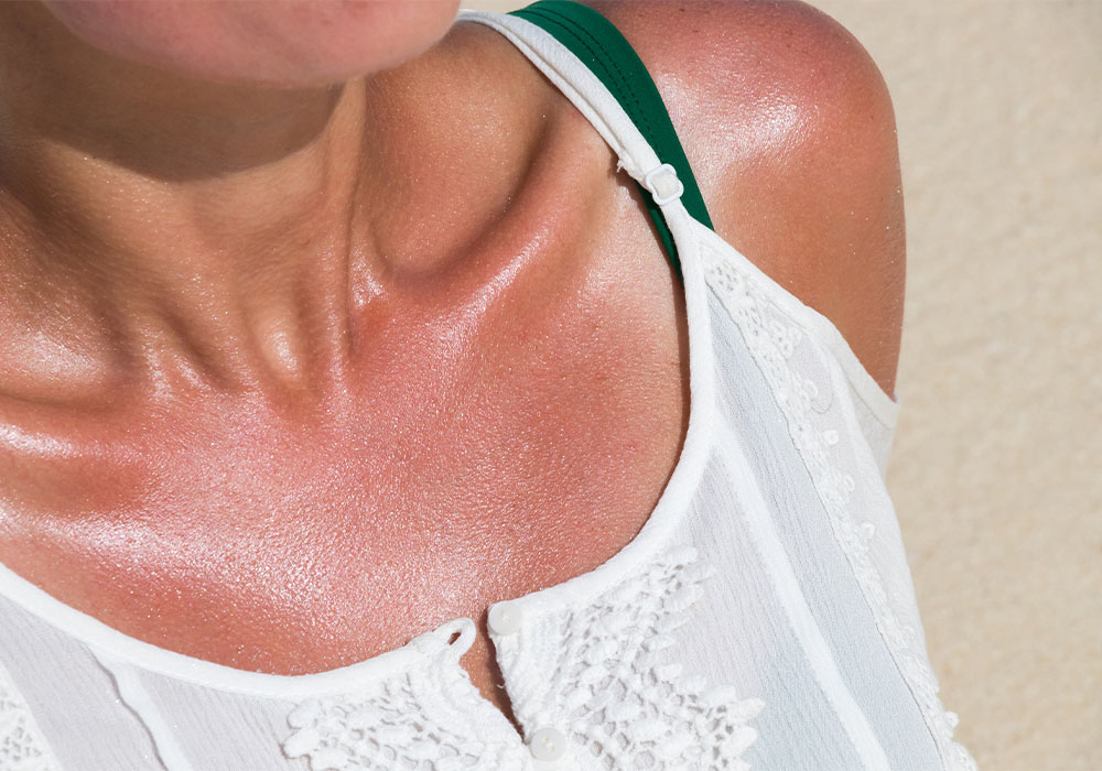 Dermatologists Share What to Do When Your Skin Peels After a Sunburn featured image