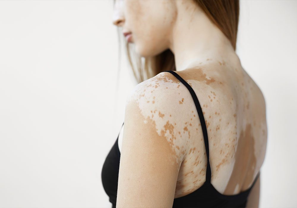 Everything to Know About Vitiligo, Including How to Best Treat It featured image