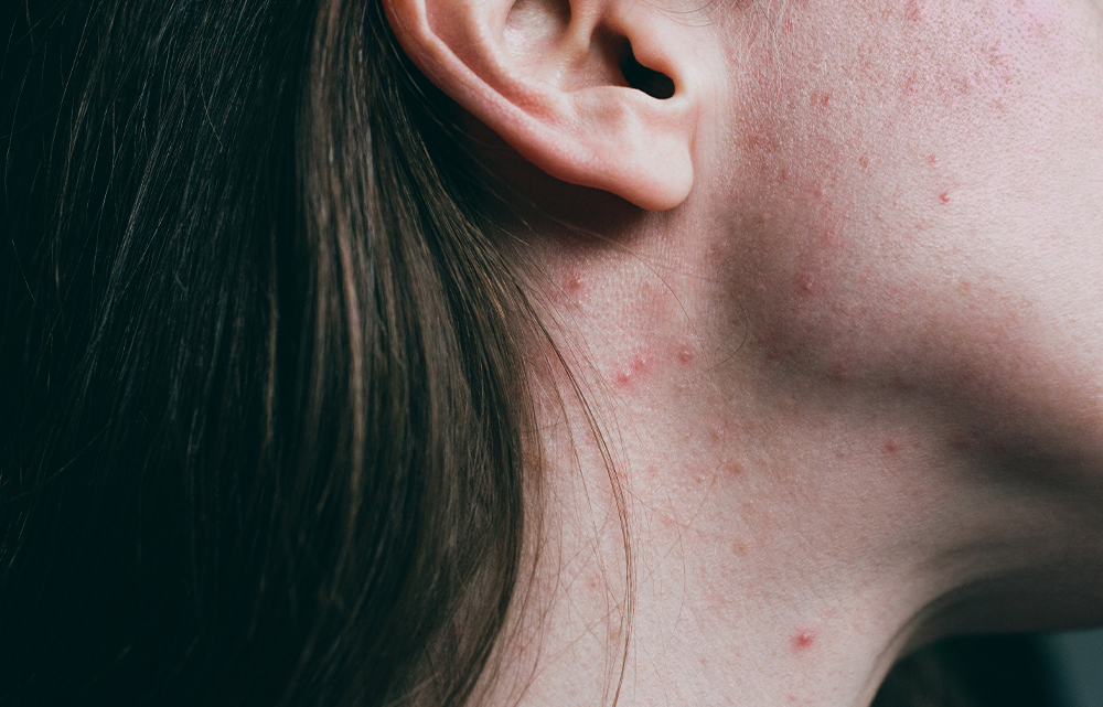 I Just Finished 6 Months on Accutane—Here’s What I Wish I Knew Before Starting featured image