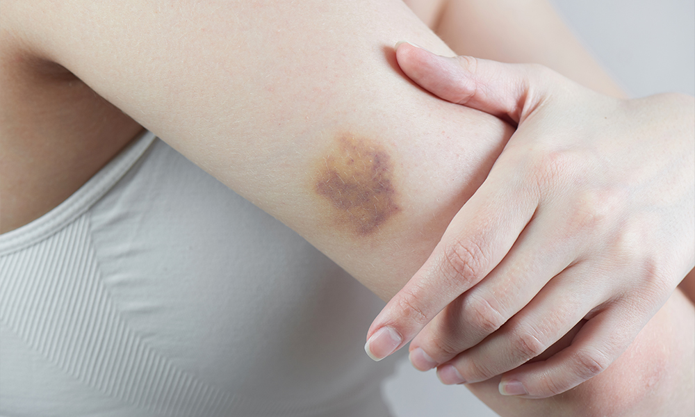 What It Means If You Bruise Easily featured image