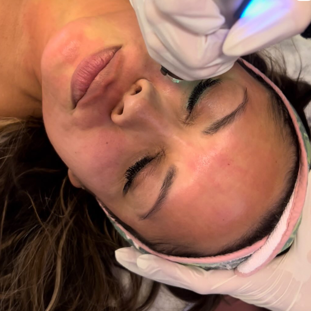 GeniusRF - The Differences Between the Most Popular Radio-Frequency Microneedling Treatments