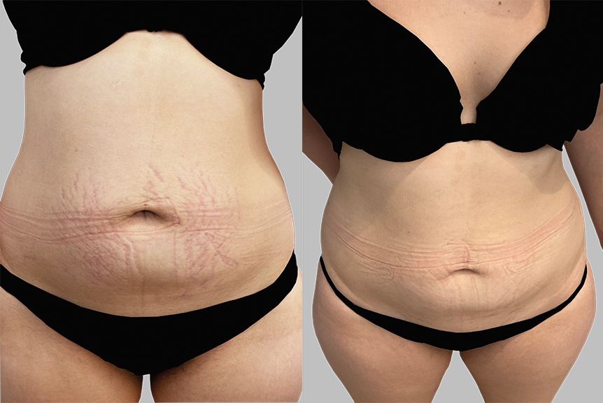 A before and after showing the treatment of stretch marks.