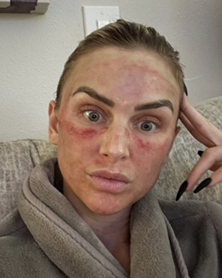 LaLa Kent Shares Bruised ‘After’ Pics of Her Under-Eye Filler Alternative