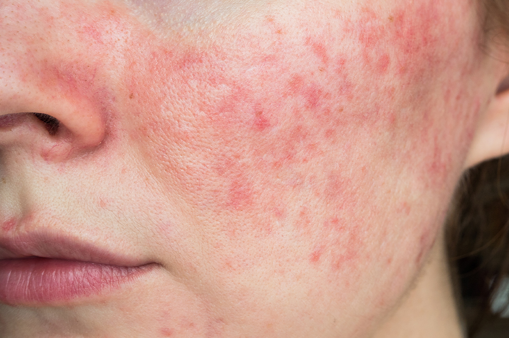 The Best Expert-Approved Rosacea Tips and Treatments to Try Next featured image