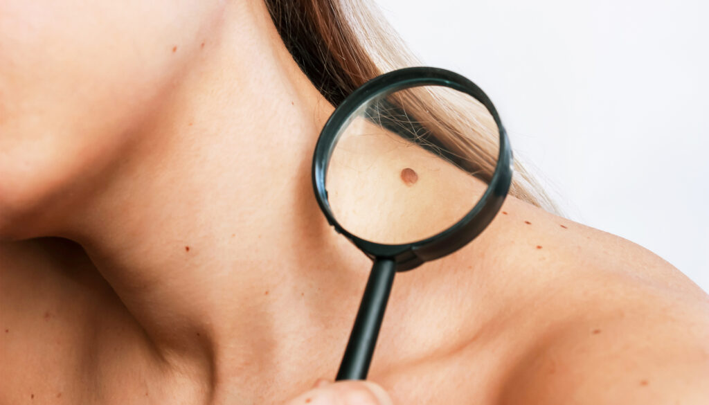 This Skin Cancer Screening Program is Helping Patients with Early Detection featured image