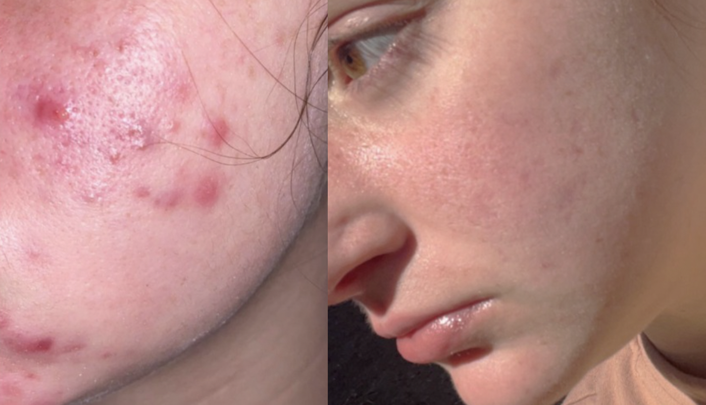 Accutane Before And After What I Wish I Knew About Isotretinoin