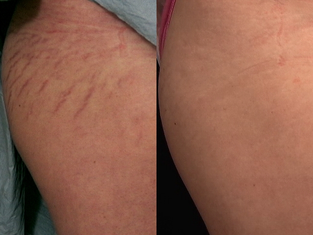 The Power of Micro-Needling as Stretch Marks Removal Treatment