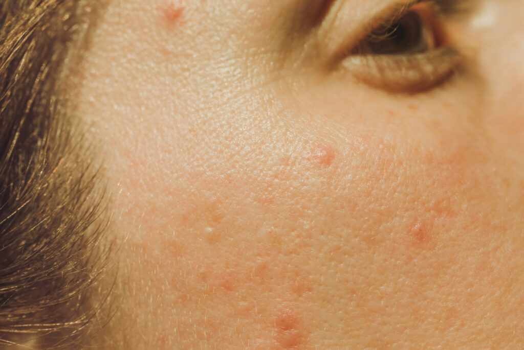 Transform Your Skin With Acne Laser Treatments: A Dermatologist-Approved Guide featured image