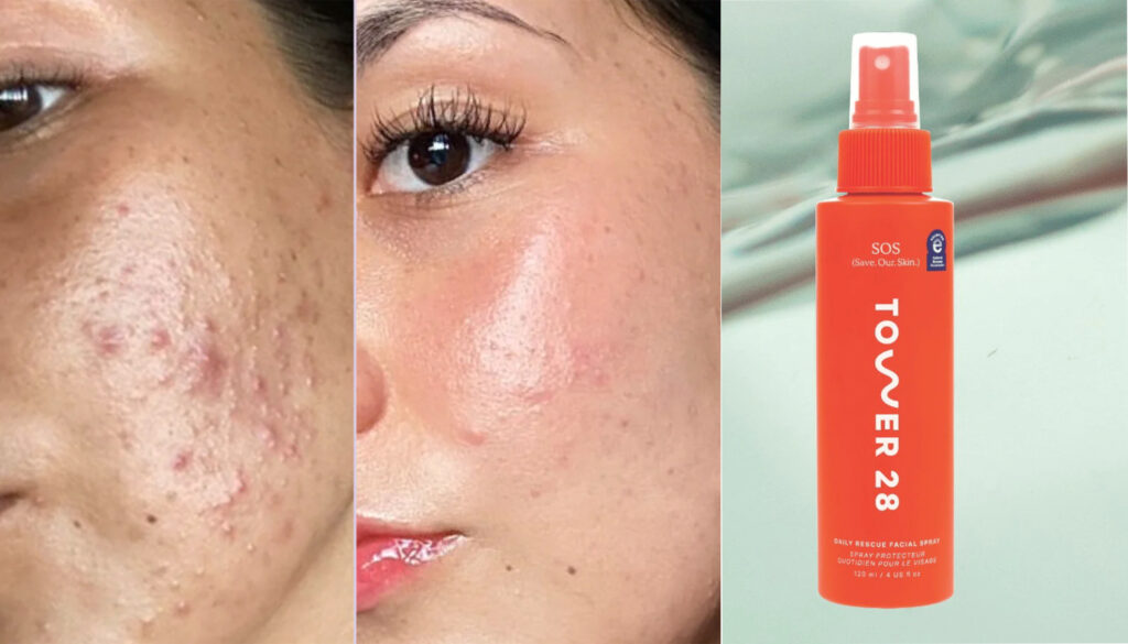 Say Goodbye to Bacteria With Hypochlorous Acid in Skin Care featured image