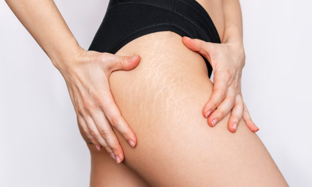 The Best Treatments for Stretch Marks, According to Derms featured image