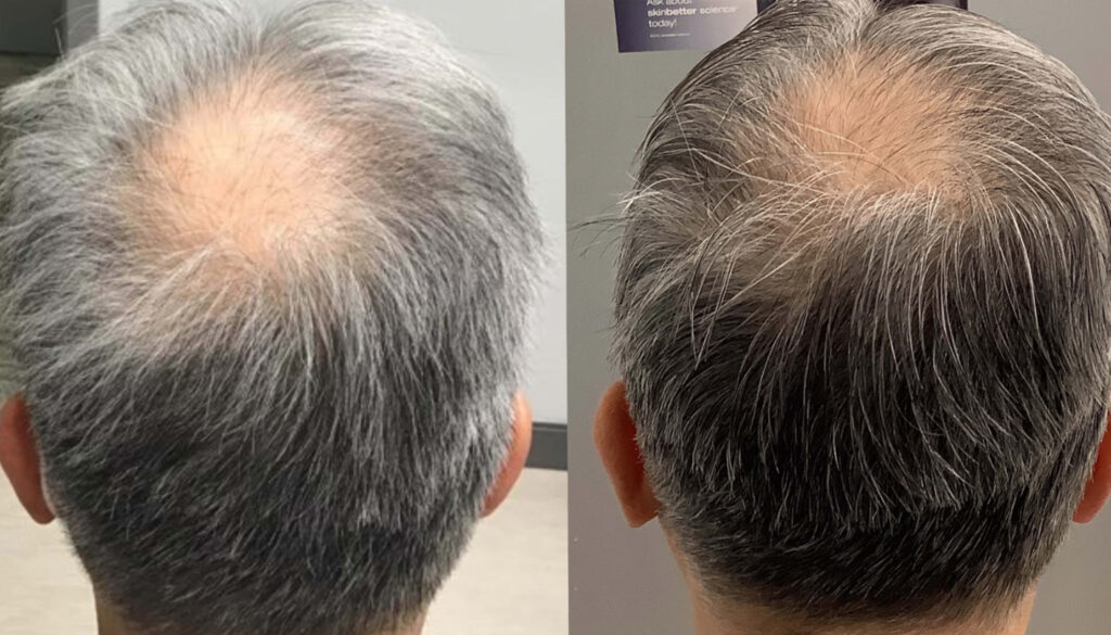 Exclusive: There’s a New Non-Invasive Hair-Loss Solution on the Market featured image