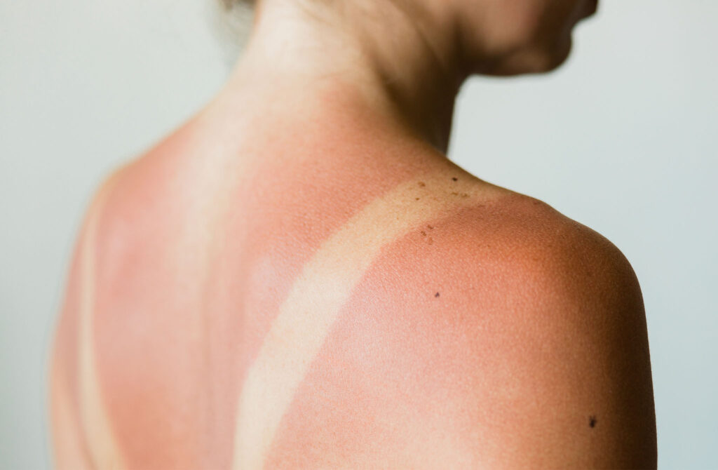 Never Put These Things on Your Sunburn, Doctors Warn featured image
