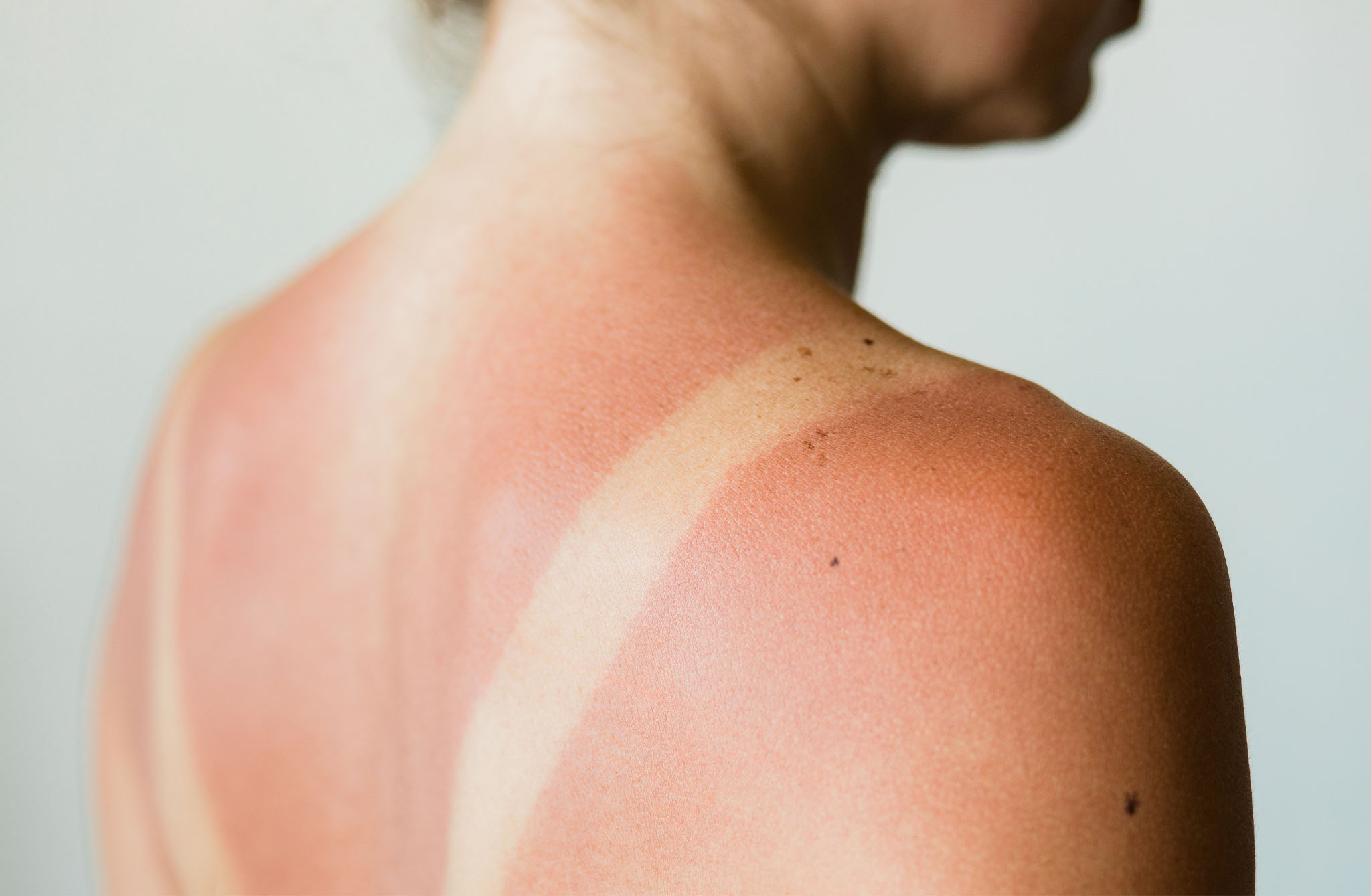 By no means Put These Issues on Your Sunburn, Docs Warn