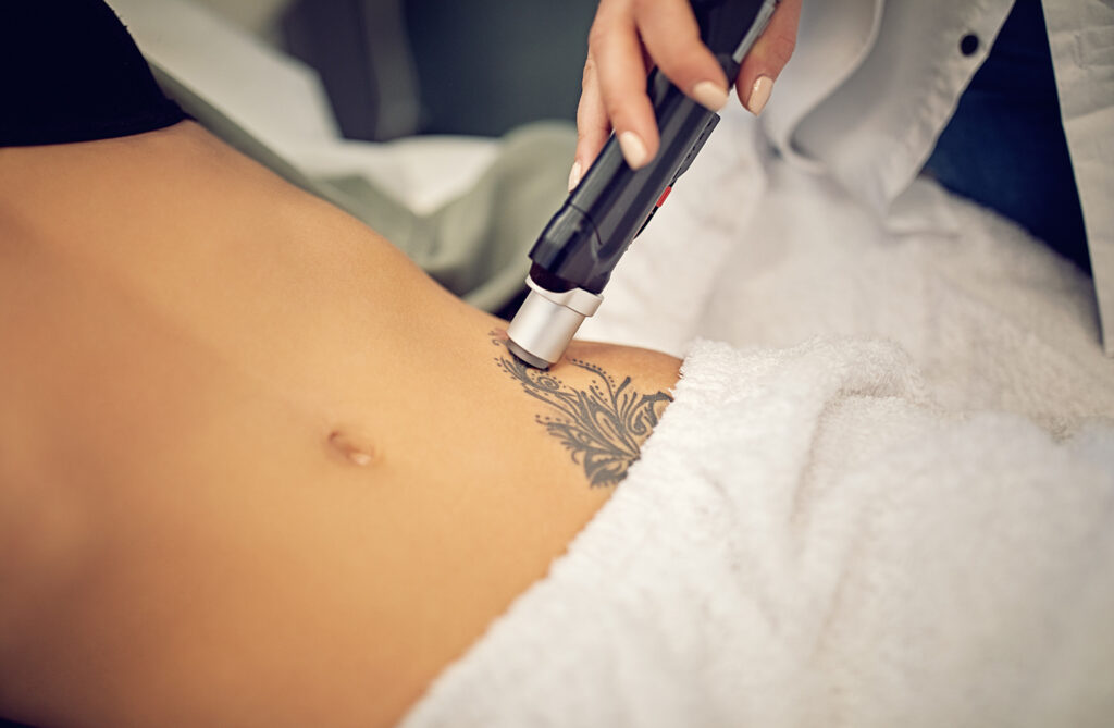 Erasing Ink: A Guide to Laser Tattoo Removal featured image