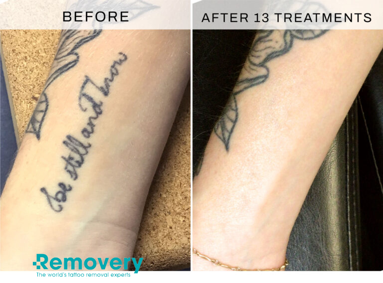 Erasing Ink: A Guide to Laser Tattoo Removal