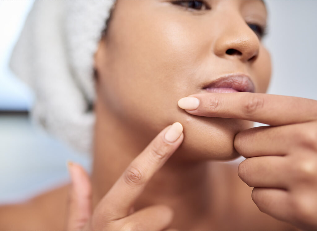 Chin Acne: Experts Reveal the Top Culprits featured image