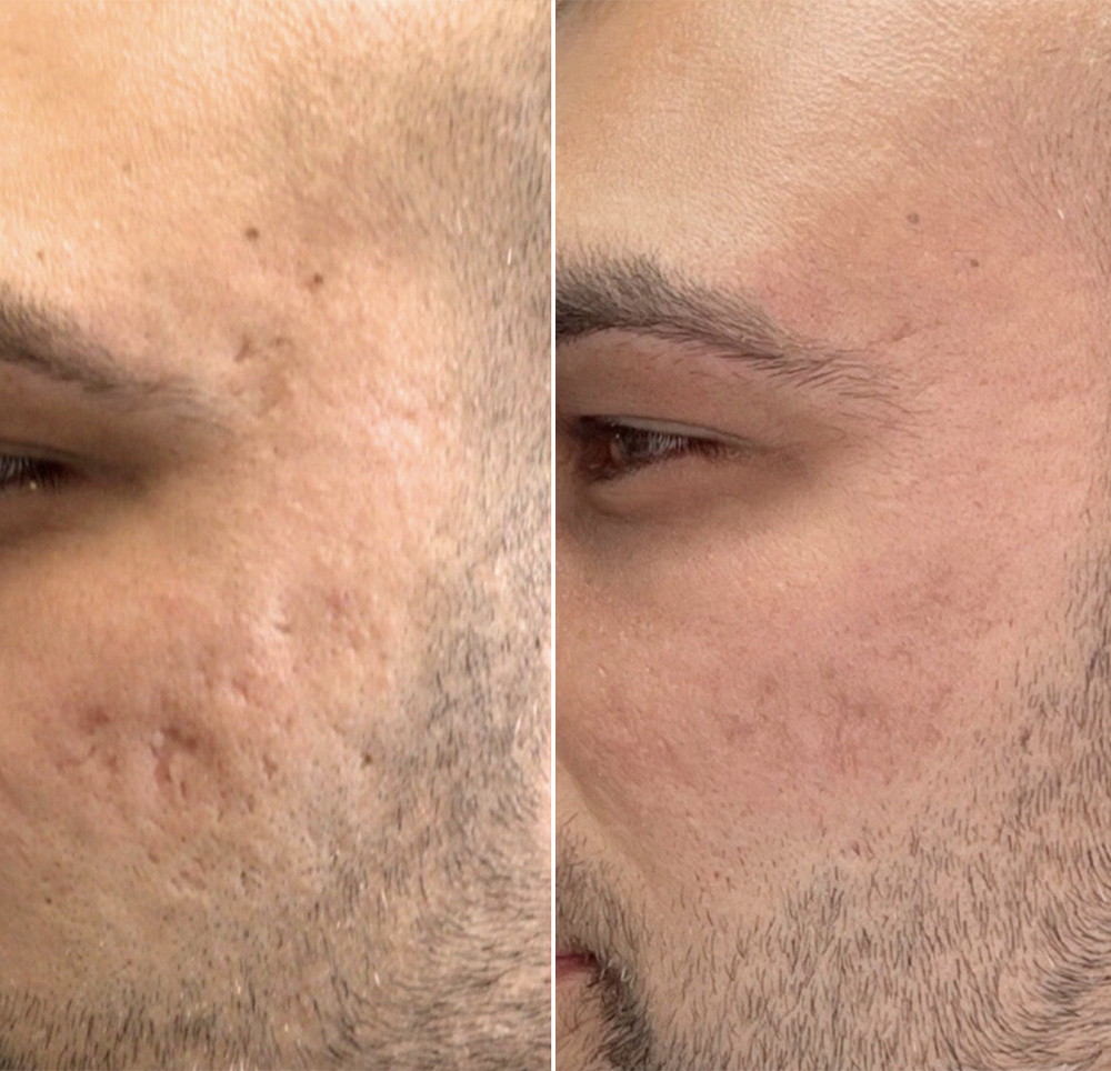 , VirtueRF: The Microneedling Device That Experts Can’t Stop Recommending to Their Patients