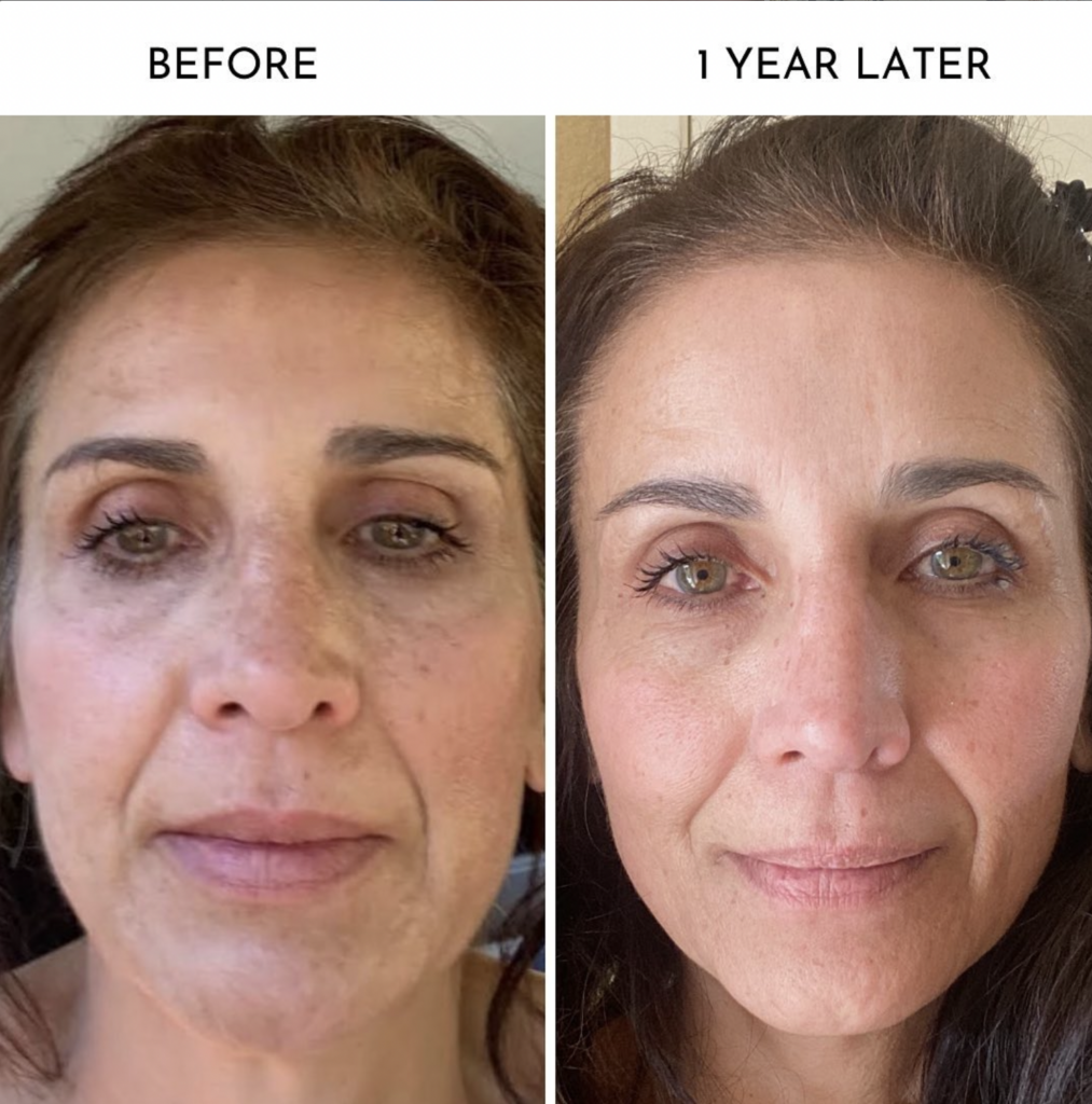 , Microneedling Before and After: Tips for the Ultimate Transformation