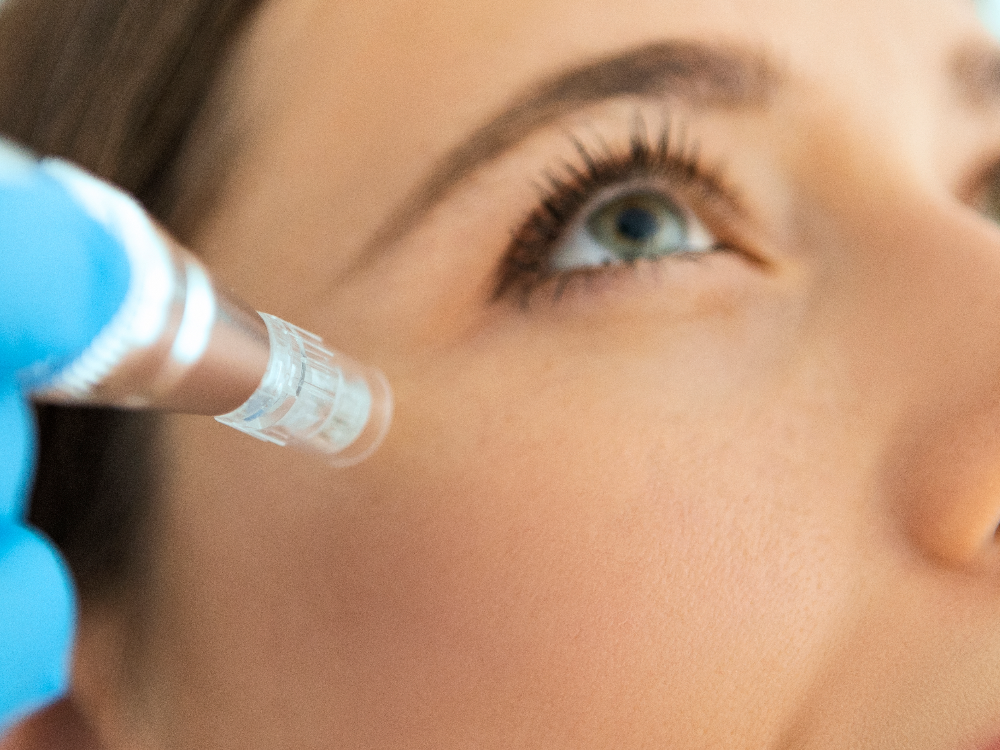 Marvelous Microneedling: The Latest Advancements in Aesthetic Treatment featured image