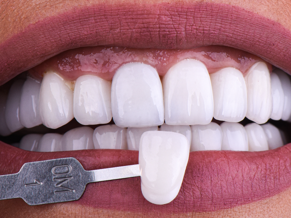 Minimal-Prep Veneers Will Help Preserve Your Smile’s Natural Beauty featured image