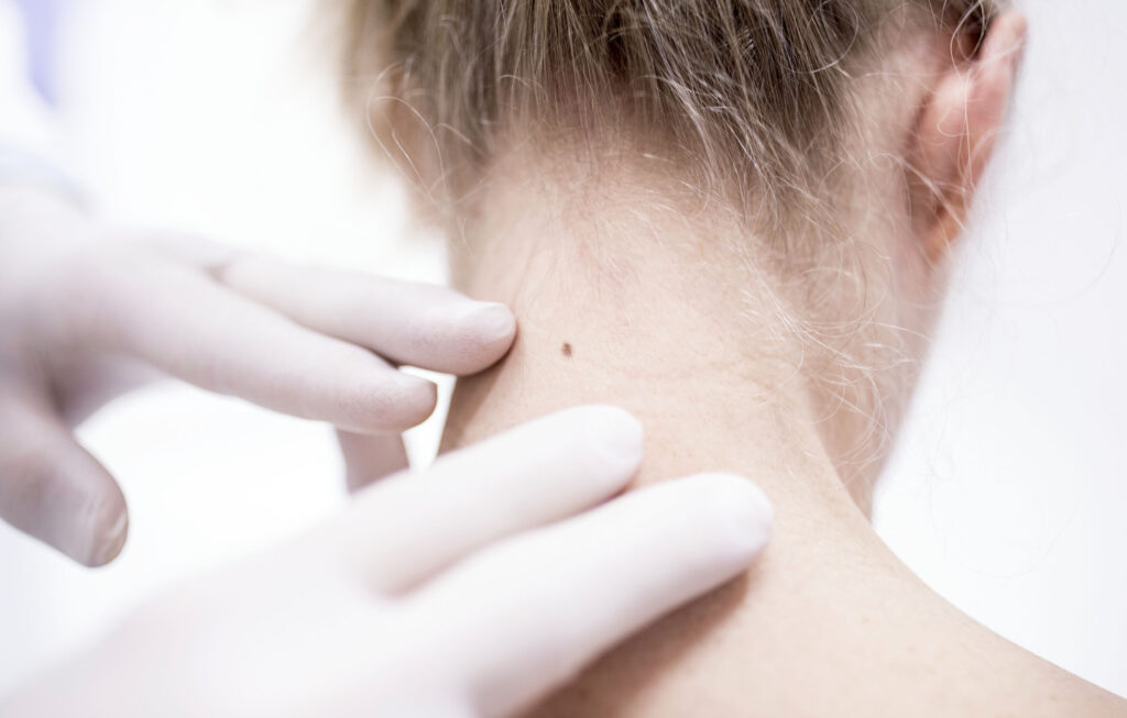 Non-Melanoma Skin Cancers a Global Health Risk, Study Finds featured image
