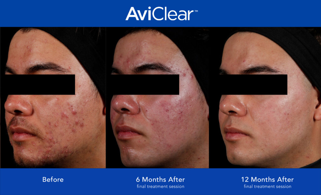 Image shows a male patient before during and after AviClear treatment for acne.