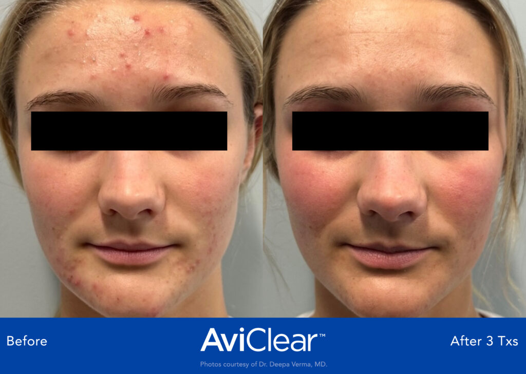 Image shows female patient's acne before and after 3 treatments of AviClear.