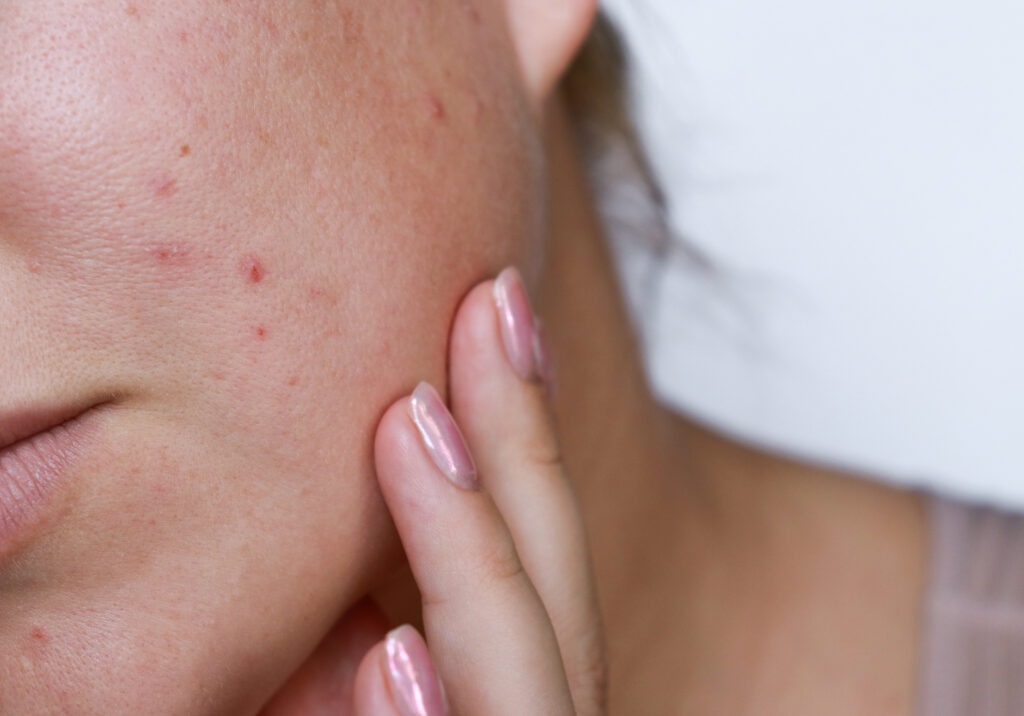Why Acne Seems Worse in the Winter and How to Treat It featured image