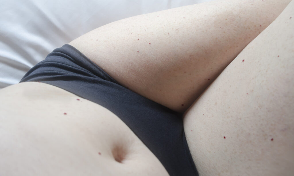 Prevent and Treat Ingrown Hairs with These Dermatologist-Approved Tips featured image